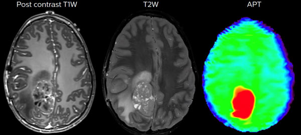20190926-diagnóstico-de-los-tumores-cerebrales-1