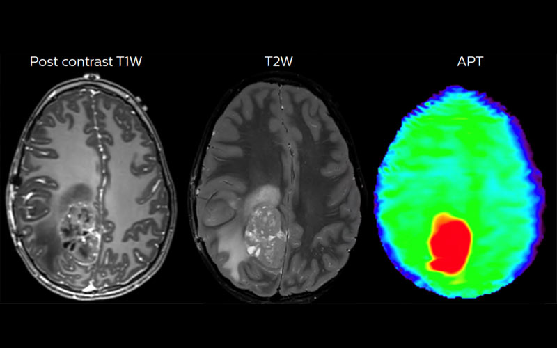 20190926-diagnóstico-de-los-tumores-cerebrales