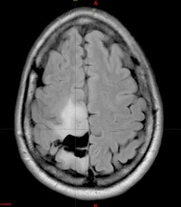 tumor-cerebral