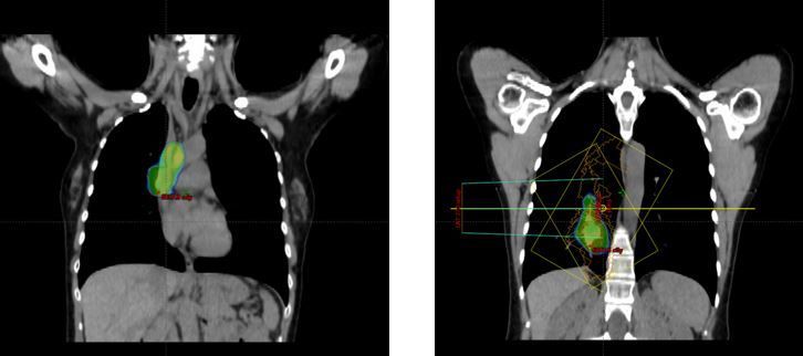 Radioterapia Adaptativa (AR)
