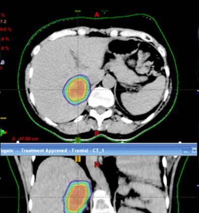 SBRT en carcinoma hepatocelular